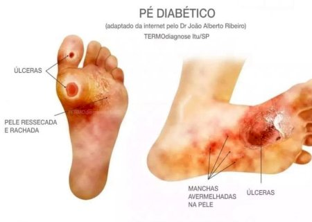 Pé Diabético? Cuidados Com os Membros Inferiores Deve Ser Redobrado