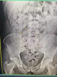 Bolivianos são flagrados com 645 cápsulas de cocaína no estômago