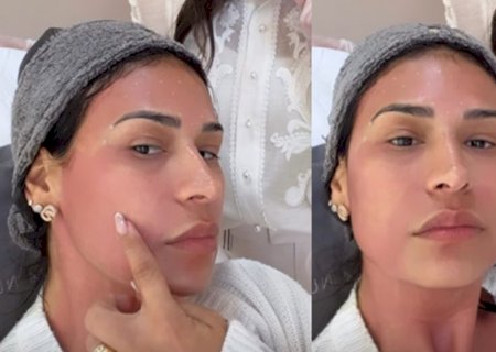 Médica esclarece tratamento de Simone Mendes após a cantora surgir com o rosto vermelho