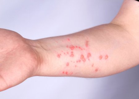 Sobe para 140 número de casos confirmados de Mpox no país em 2026